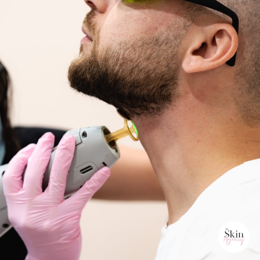 Laser Hair Removal for Men