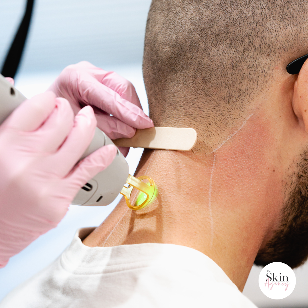 Laser Hair Removal for Men