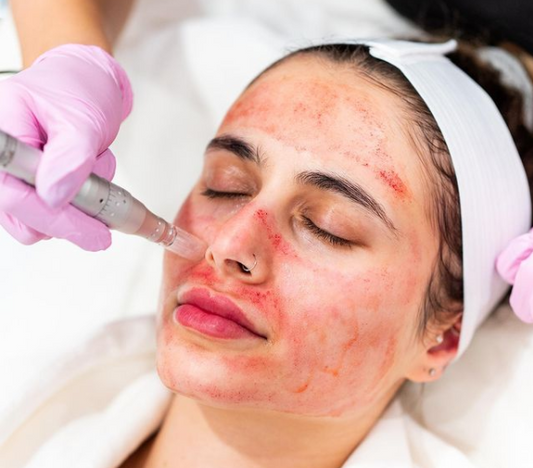 The Wonders Of Micro-Needling What To Watch Out For